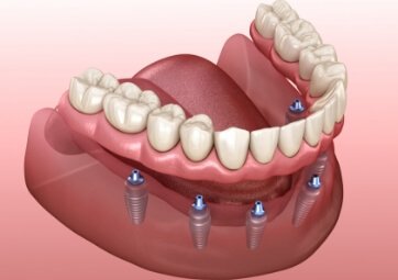 Animated dental implant supported denture placement