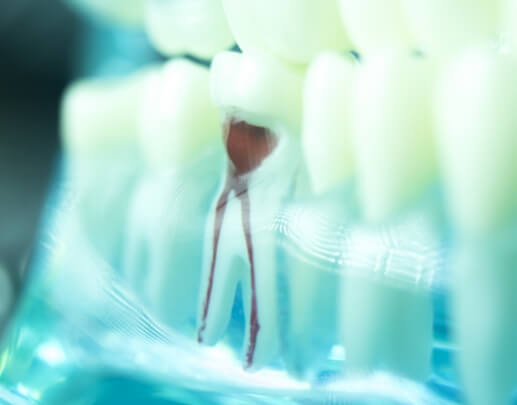 Model showing the inside of a tooth after root canal therapy
