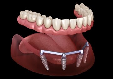 Animated denture supported by specialized dental implants for low jawbone density