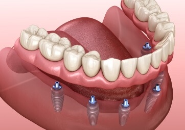 Closeup of animated dental implant supported denture