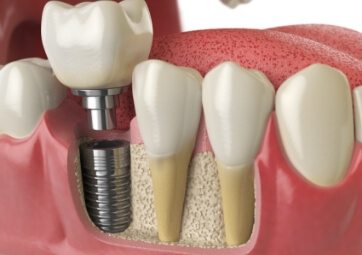 Animated smile with dental implant in place during abutment and temporary dental crown placement