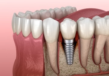 Animated smile with dental implant supported dental crown