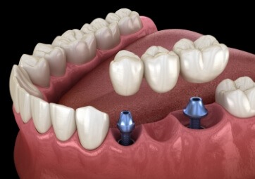 Animated smile during dental implant supported fixed bridge placement