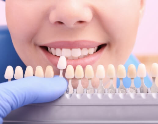 Woman's smile compared with tooth colored fillings